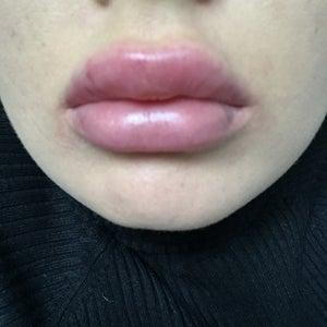 Eating, Sleeping and Kissing After Lip Filler Injections
