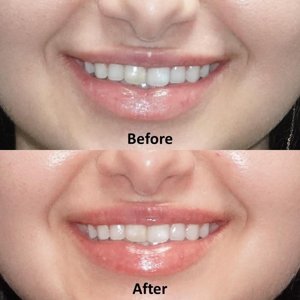 Lip Flip Botox Before And After Photos