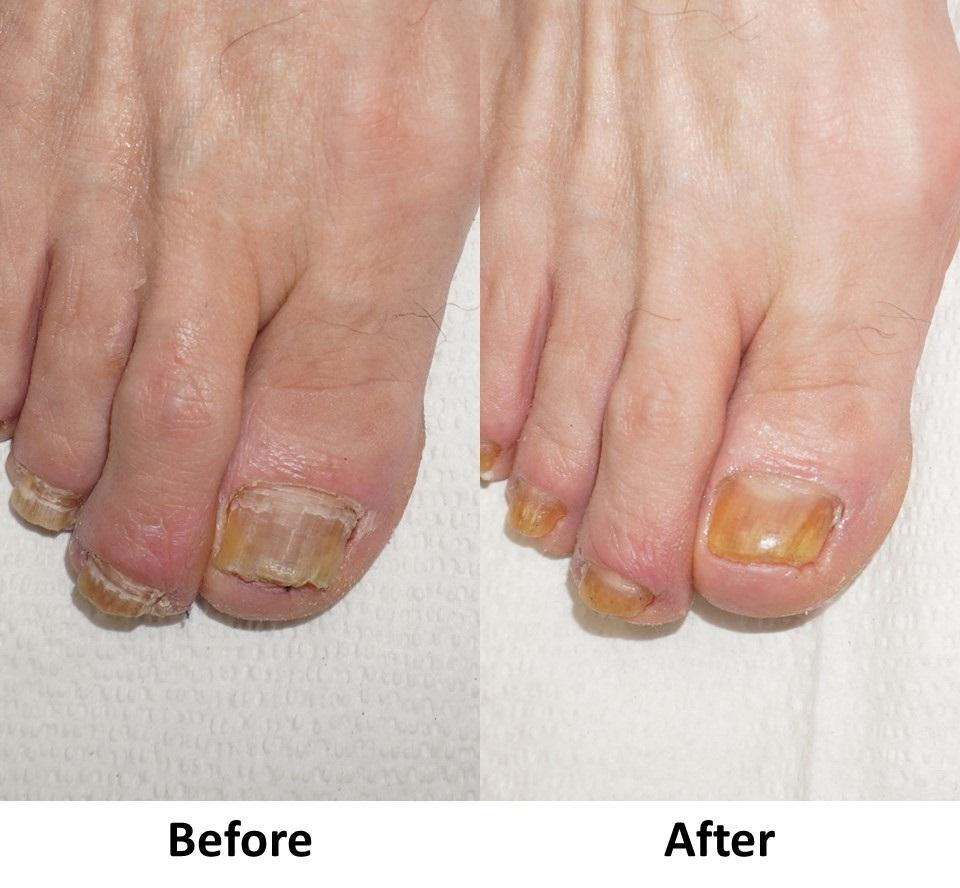 Laser toenail fungus treatment