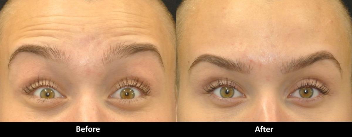 Botox Before and After Results - Everything You Need to See & Know