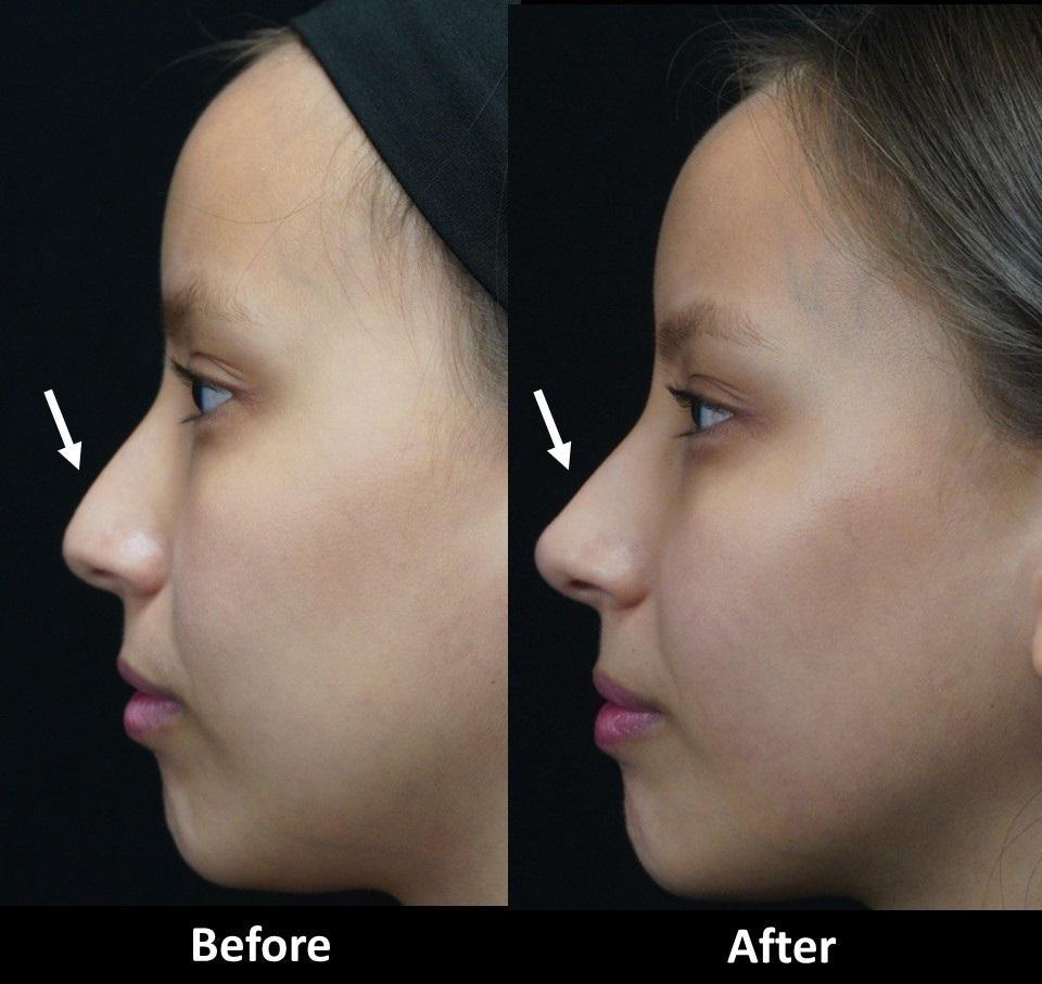 improve-the-appearance-of-your-nose