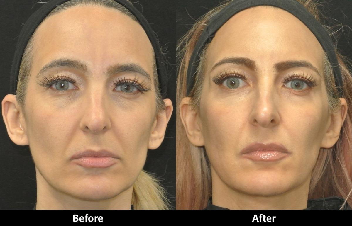 anyone has any experience with hyaluronic acid filler to fill in