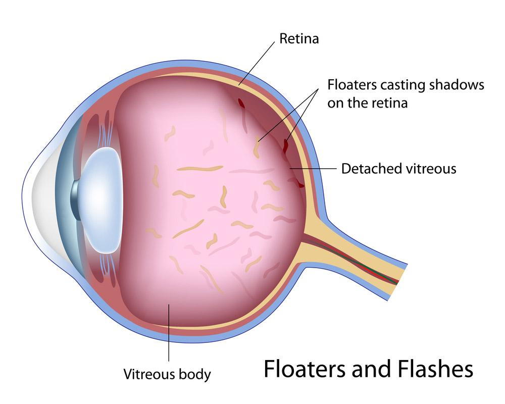 What are Flashes and Floaters