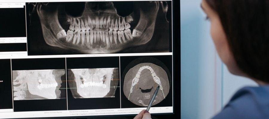 The Evolution and Significance of Digital Dental X-rays