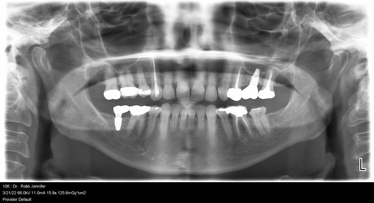 What Is A Panoramic Dental Xray And What Is It Used For