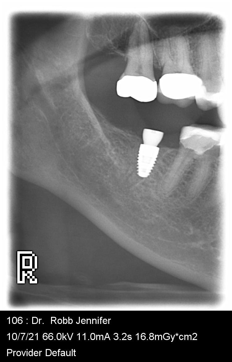 periapical x ray