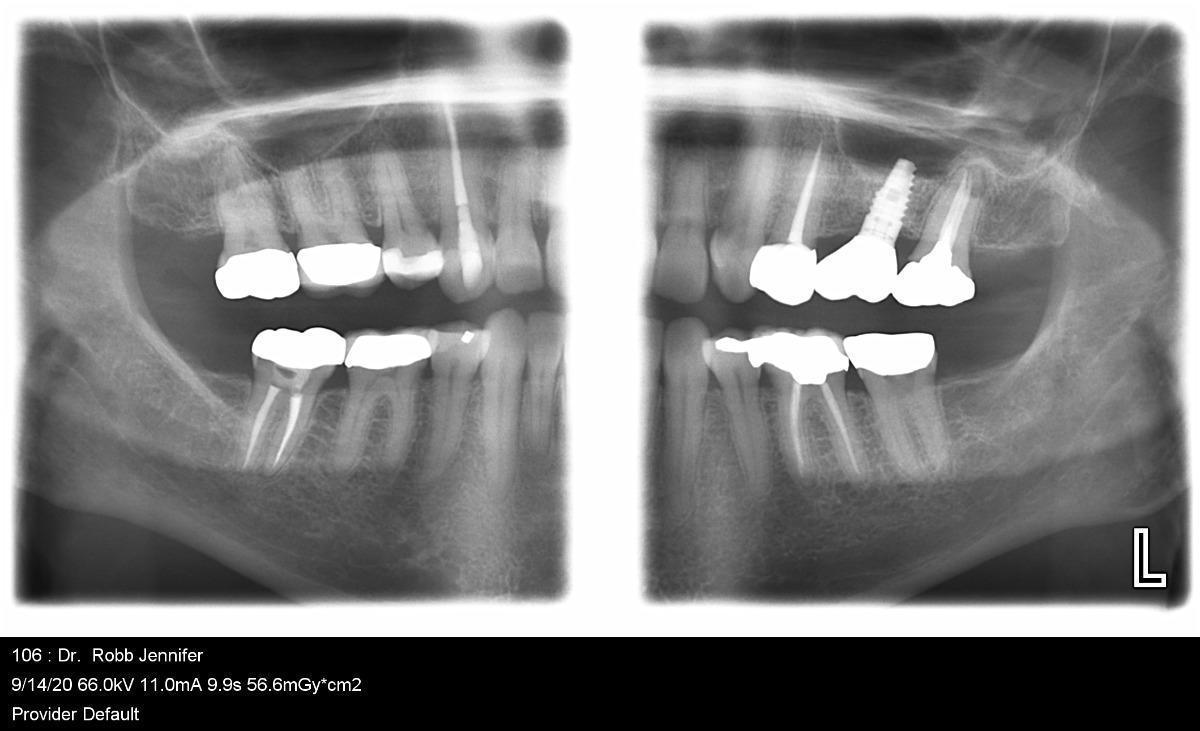 taking bitewing dental x rays