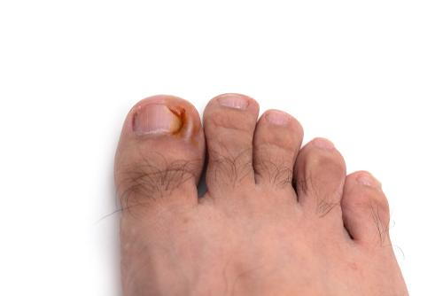 Ingrown toenail condition on white background