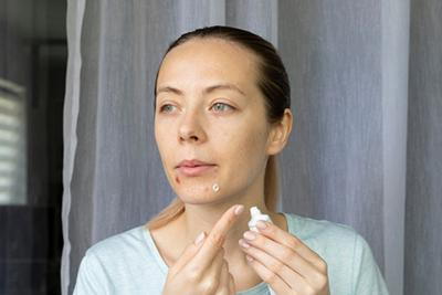Woman-with-Acne-Problem