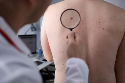 Patient-Undergoing-Mole-Examination-by-Dermatologist