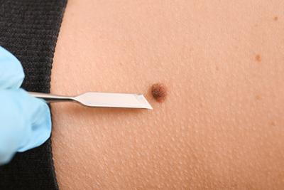 Mole removal on a person with sharp clinical knife.