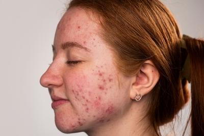 Woman with Acne infection on her face.