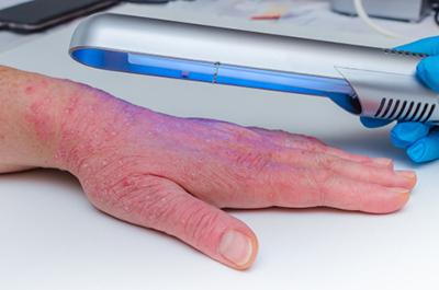 UV light therapy session for psoriasis