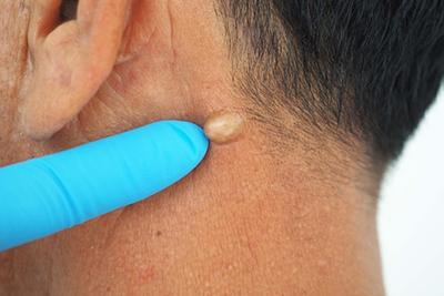 Close-up of sebaceous cyst being assessed for removal by dermatologist.