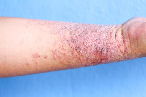 Close-up of a wrist affected by eczema
