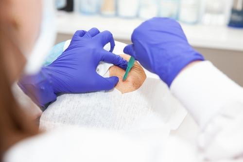 A dermatologist performing Mohs surgery, removing skin tissue for biopsy.