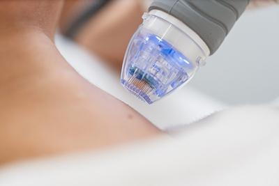 Microneedling-Boosts-Collagen-Production