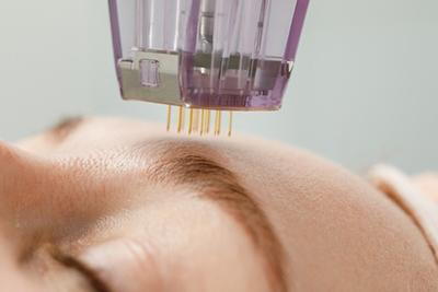 Close-Up-of-Skin-Undergoing-Microneedling-Therapy