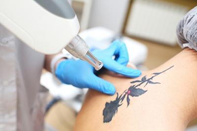 Doctor using laser device for tattoo removal treatment