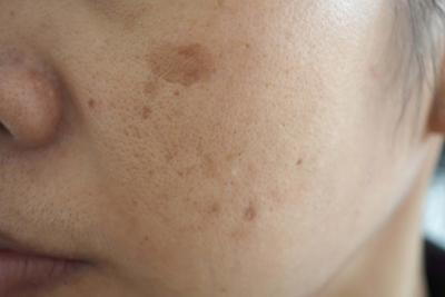 Female patient with hyperpigmented skin on cheek