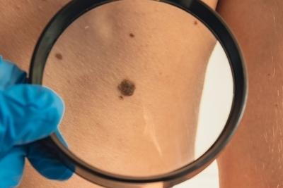 Illustration of Melanoma on skin of a person