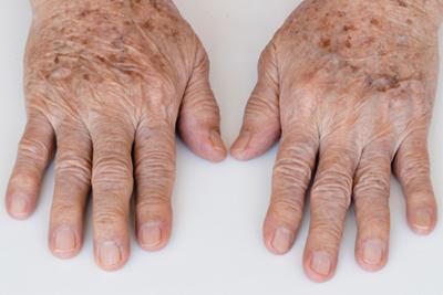 Close-up of senior man's hands with age spots