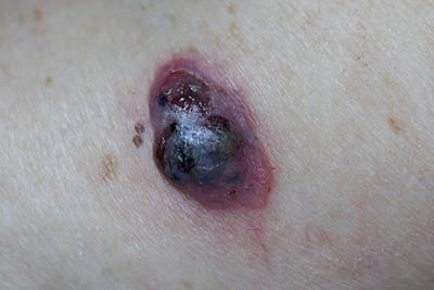 Illustration of sweling of Malonoma on skin