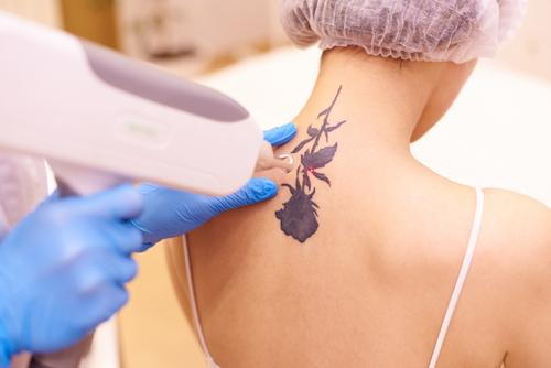 A woman receiving laser tattoo removal treatment from a dermatologist.