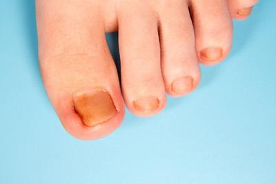 Close-up-of-a-toe-with-an-ingrown-toenail-treated.