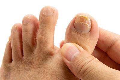 Hand-holding-toe-with-thick,-discolored-toenail