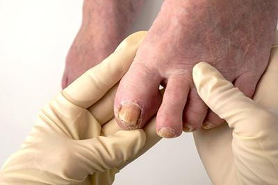 Doctor-holding-foot-with-fungus-toenail-condition