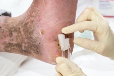 Wound care for diabetic foot with clinical assistant hand with gloves.