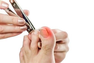 Illustration of ingrown toenail in red