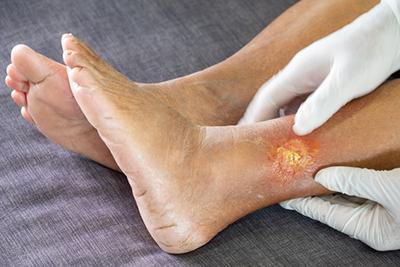 Podiatrist-Examines-Foot-With-Gangrene-Diabetic-Foot-Care-Concept