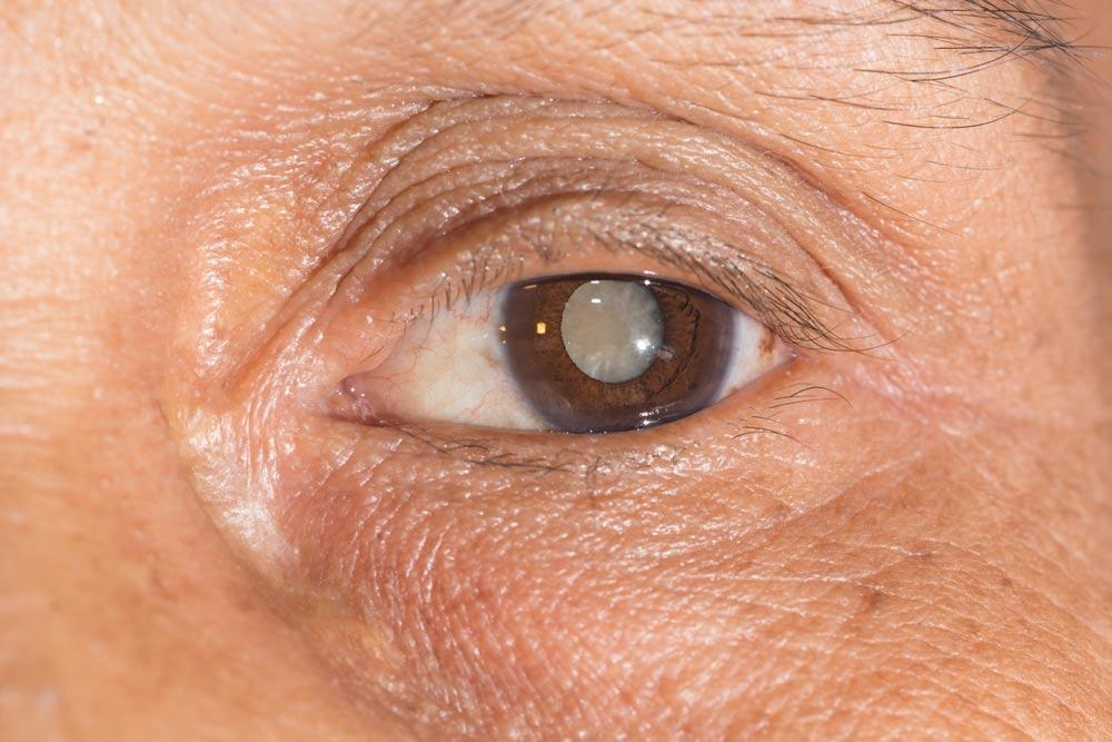 Eye Cataracts