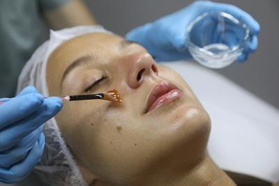 Dermatologist-Treating-Client's-Acne-Scars-With-Chemical-Peels