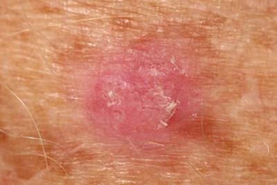 Close-up-Photo-Showing-Squamous-Cell-Carcinoma
