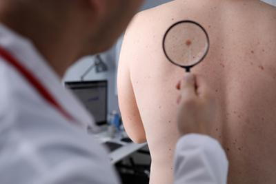 Male-Patient-Undergoes-Annual-Mole-Screening-for-Skin-Cancer