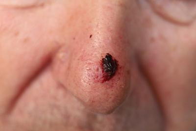 Basal cell carcinoma appearing as a bump on the nose