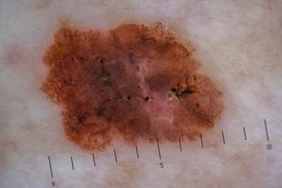 Detailed close-up of skin melanoma
