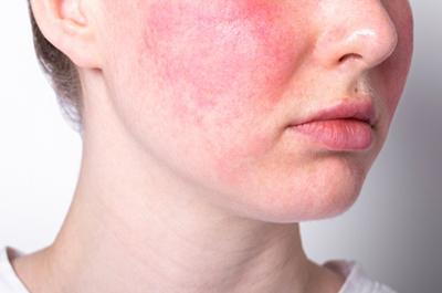 Illustration of Rosacea on womans face with redness