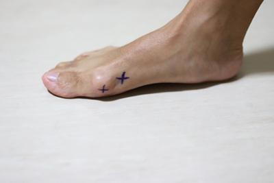 Patient's-Foot-Ready-for-Minimally-Invasive-Bunion-Surgery