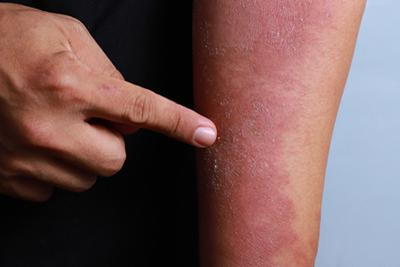 Illustration of Psoriasis on skin of a person