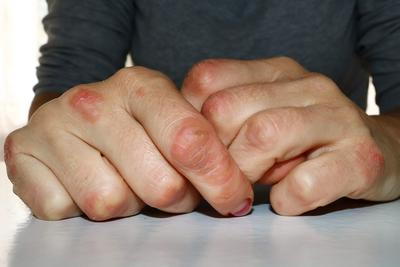 Close-up of hands with dry red patches from eczema flare-ups