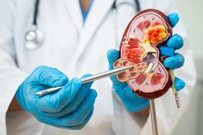 Doctor-Shows-What-Chronic-Kidney-Disease-Looks-Like