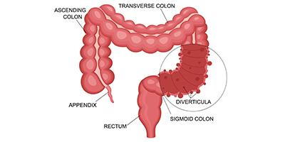 Diverticulosis-Concept