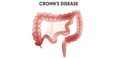 Crohn's-Disease