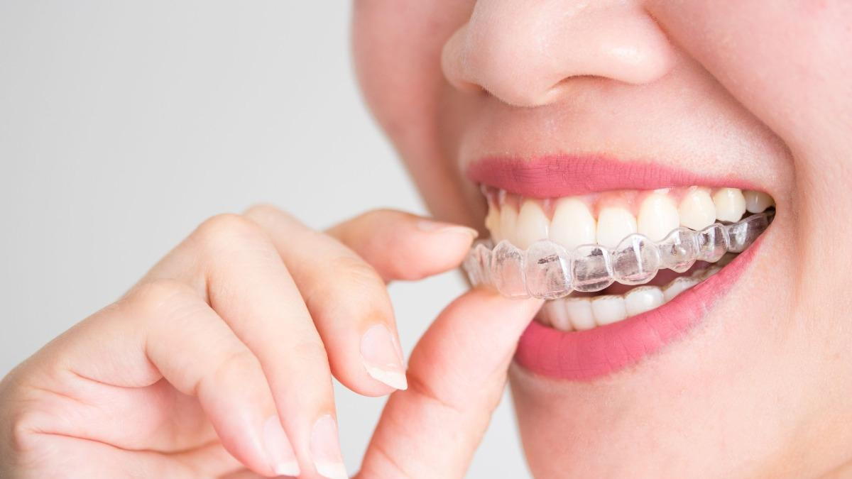 Close-up of a woman putting an Invisalign tray in her mouth