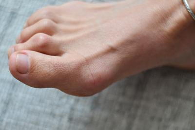 Foot with hammertoe condition in a person.