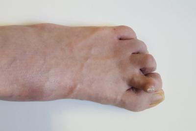 Illustration of hammertoes condition on a persons foot